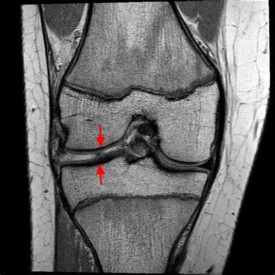 Does an X-Ray Show Torn Ligaments? Exploring the Invisible Threads of Medical Imaging